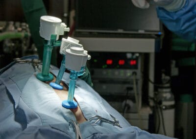 Drei Trokare im Bauchraum ermöglichen das Einführen von optischen und chirurgischen Instrumenten.n