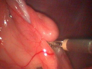 Endoskopische Kastration der Hündin mit der Koagulationszange wird das Eierstockband und das Blutgefäß ligiert