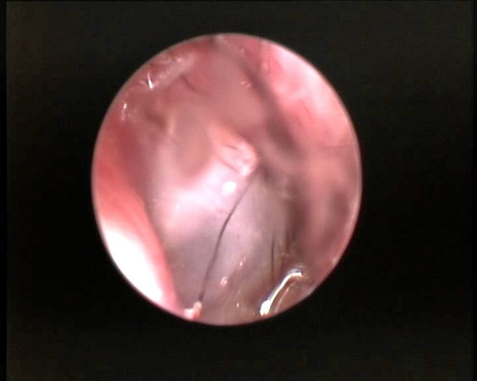 endoskopischer Blick auf das Trommelfell im Ohrkanal